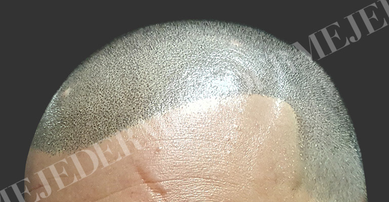 Tricopigmentazione soluzione calvizie alopecia